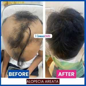 Alopecia Areata transformation: Before - noticeable hair loss patches. After - remarkable regrowth, thanks to Homeopathic Treatment for Alopecia Areata